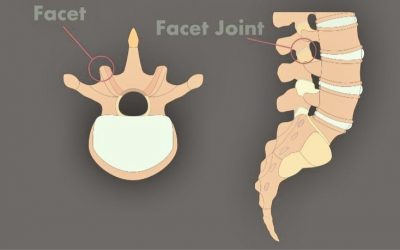 Facet Joint Syndrome