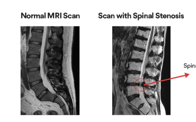 Spinal Stenosis: What It Is and Why Prevention Matters